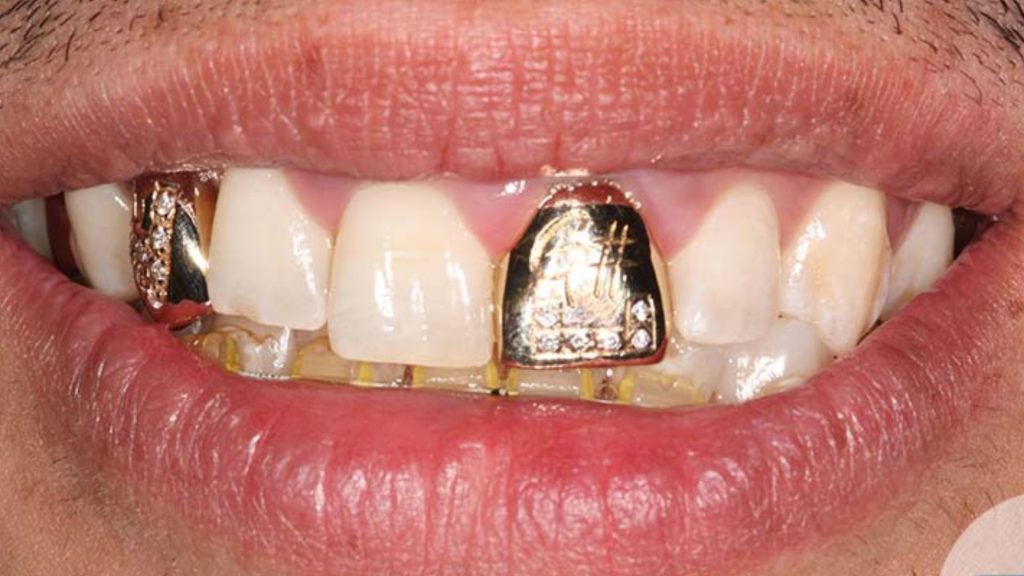 Illustrative example of gold dental implants from Google Search