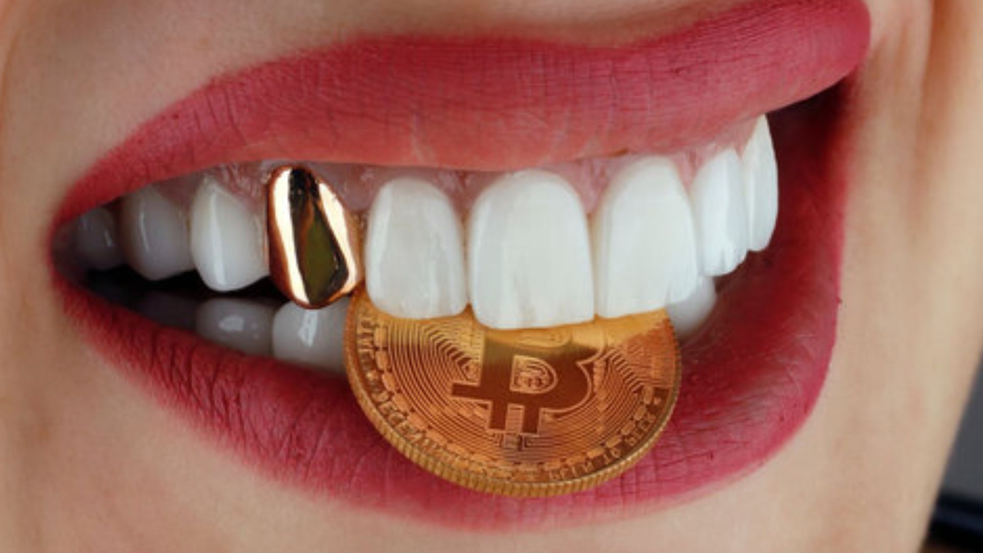 Illustrative example of gold dental implants from Google Search