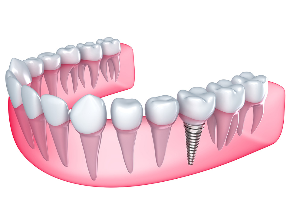 Illustrative example of guide to dental implants from Google Search