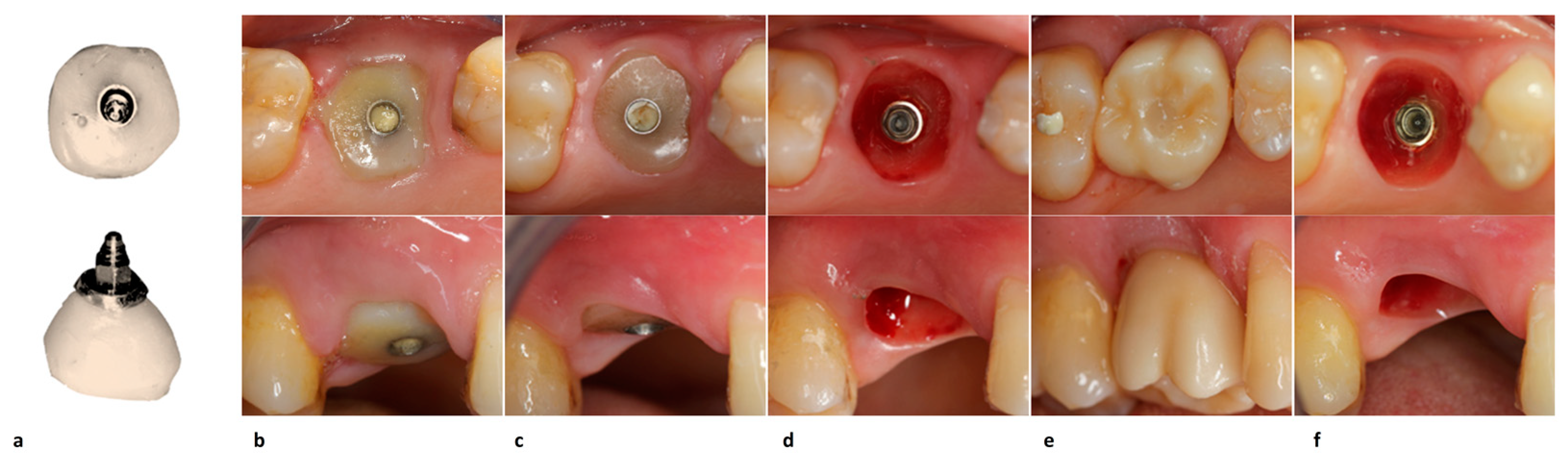 Illustrative example of healing process for dental implants from Google Search