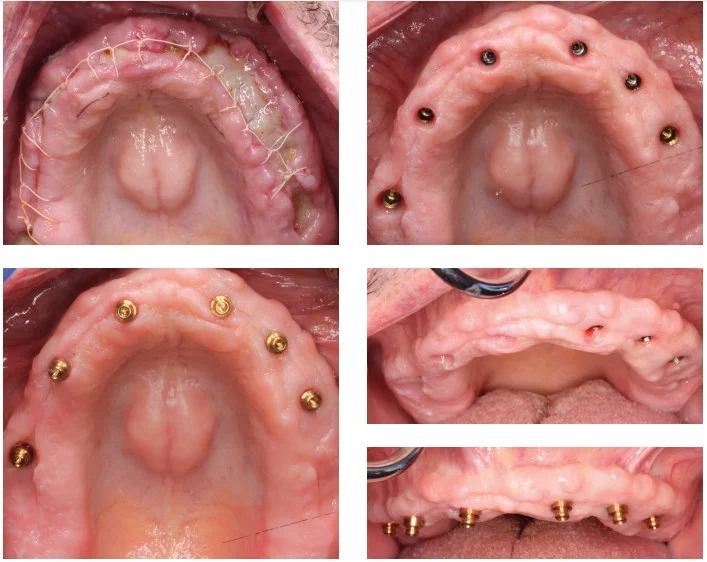 Illustrative example of healing process for dental implants from Google Search