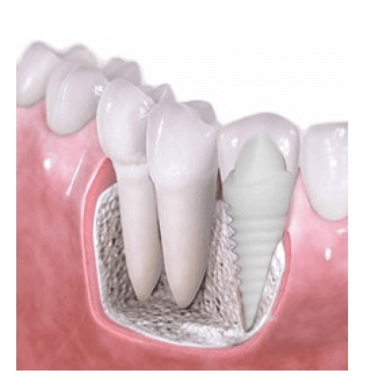 Illustrative example of holistic dental implants from Google Search
