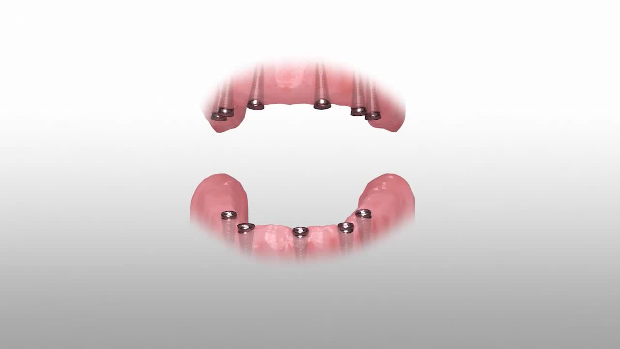 Illustrative example of hybridge dental implants from Google Search