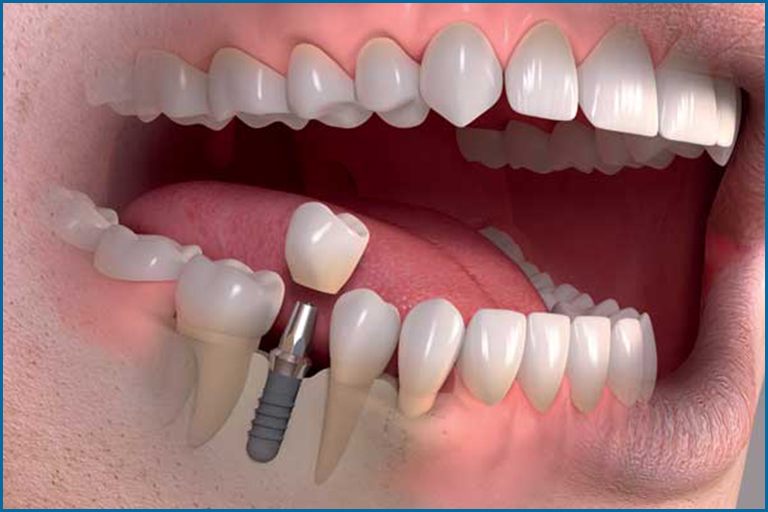 Illustrative example of immediate dental implants from Google Search