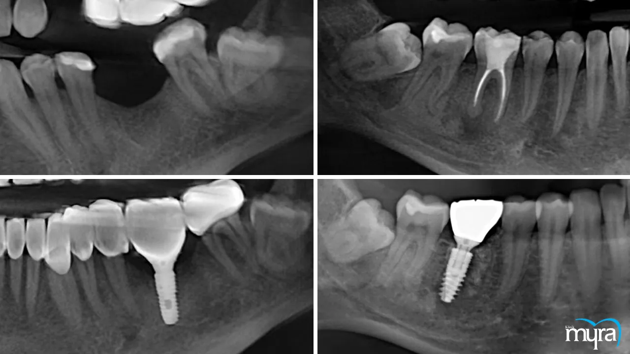 Illustrative example of immediate load dental implants from Google Search