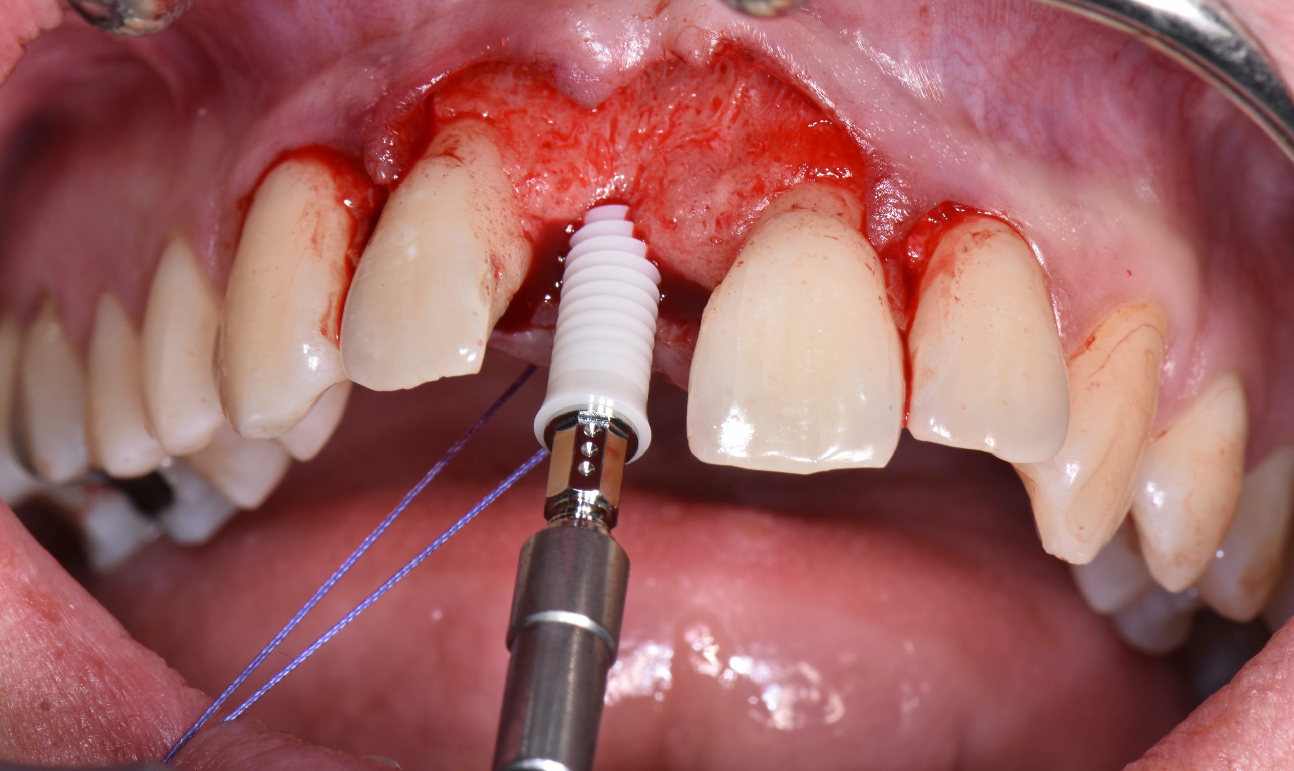 Illustrative example of individual dental implants from Google Search