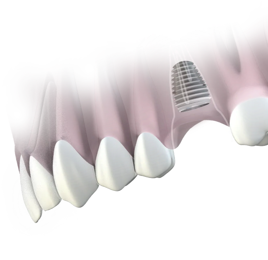 Illustrative example of keystone dental implants from Google Search