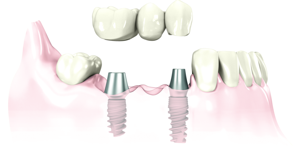 Illustrative example of legacy dental implants from Google Search