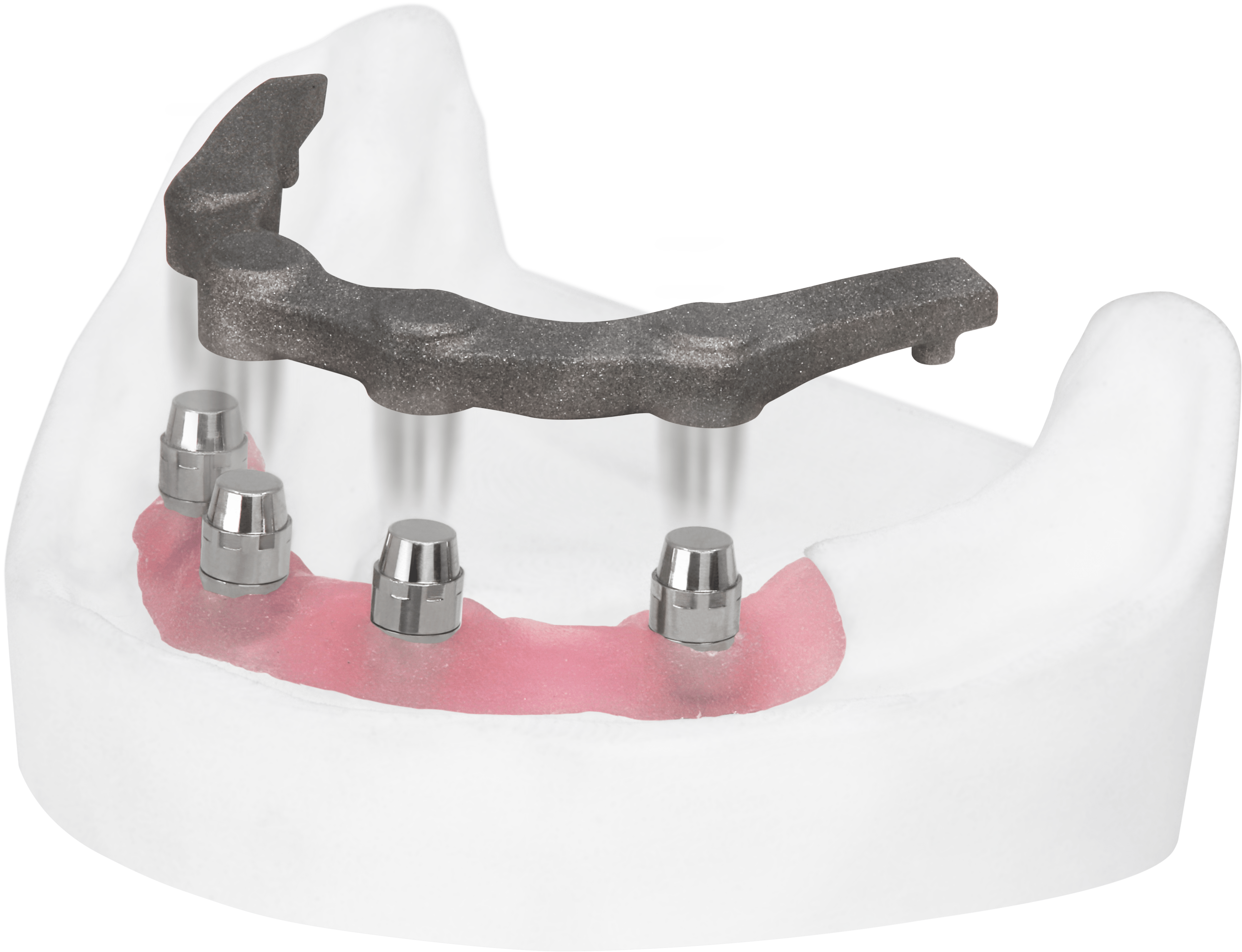 Illustrative example of magnetic dental implants from Google Search