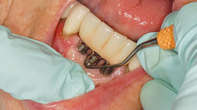 Illustrative example of maintenance of dental implants from Google Search
