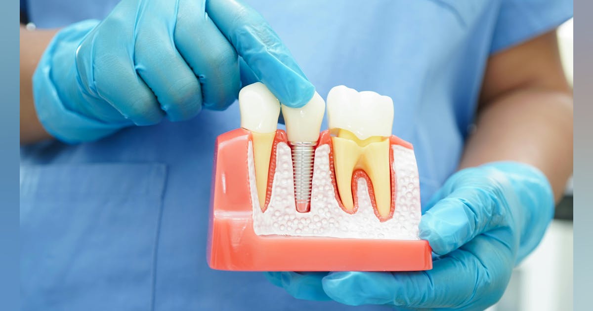 Illustrative example of maintenance of dental implants from Google Search