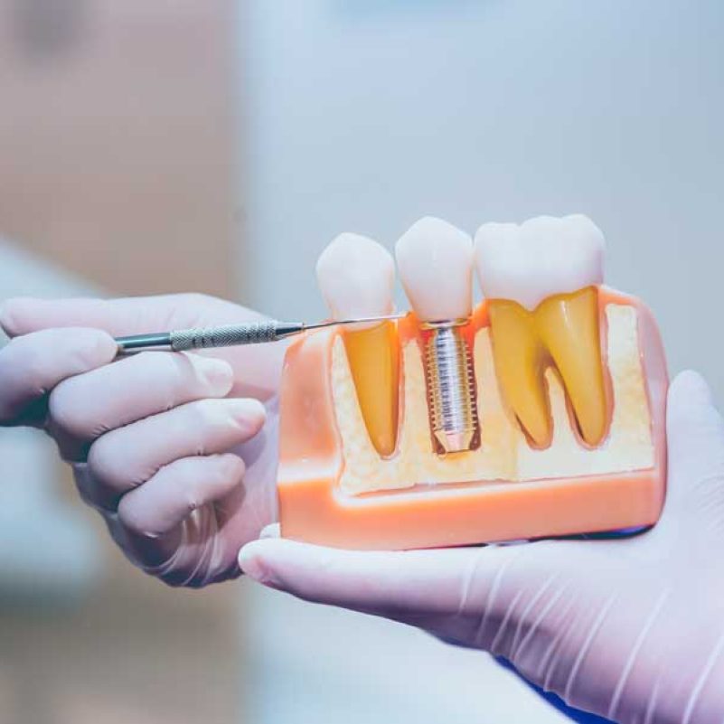 Illustrative example of medically necessary dental implants from Google Search
