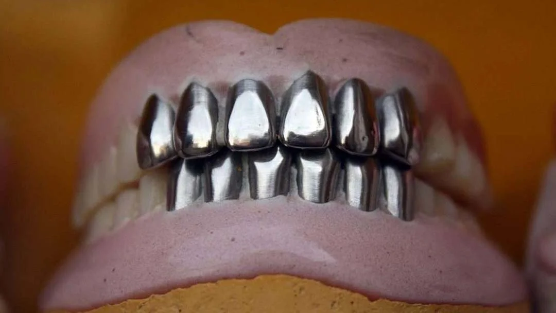 Illustrative example of metal dental implants from Google Search
