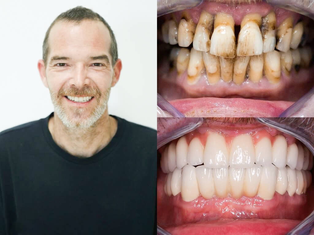 Illustrative example of mexican dental implants from Google Search