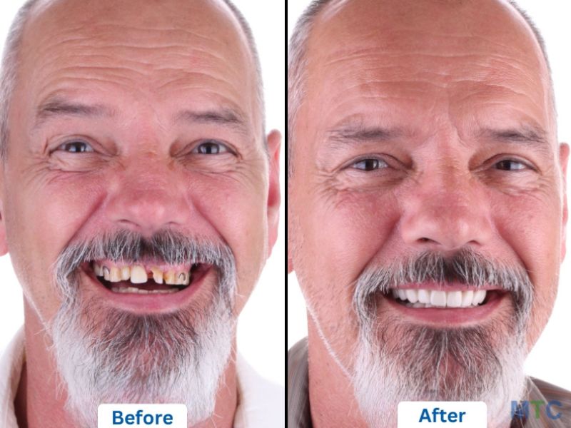 Illustrative example of mexican dental implants from Google Search