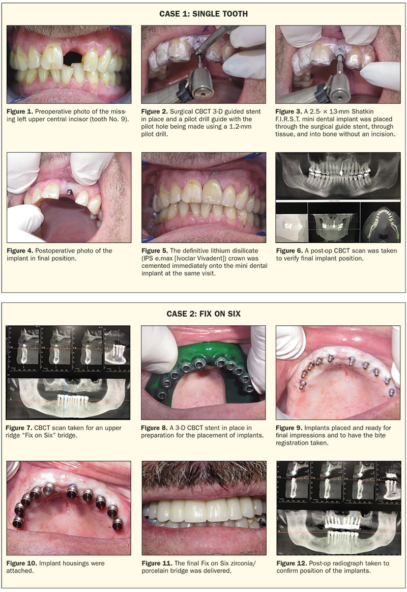Illustrative example of mini dental implants reviews from Google Search