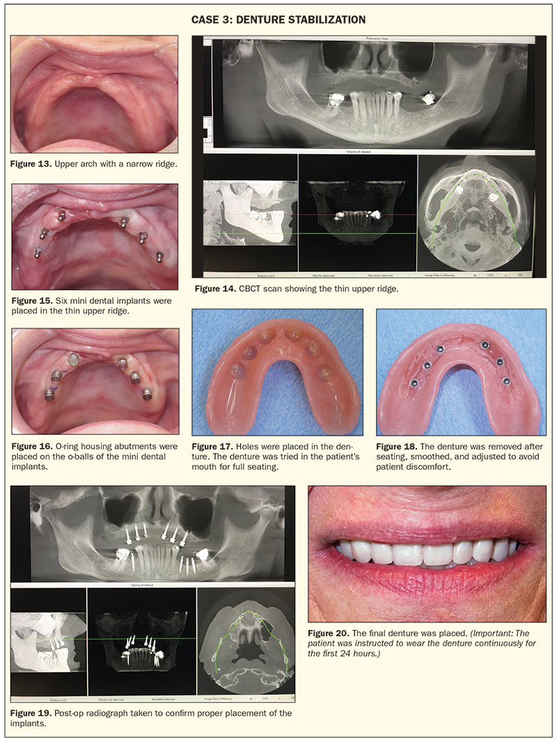 Illustrative example of mini dental implants reviews from Google Search