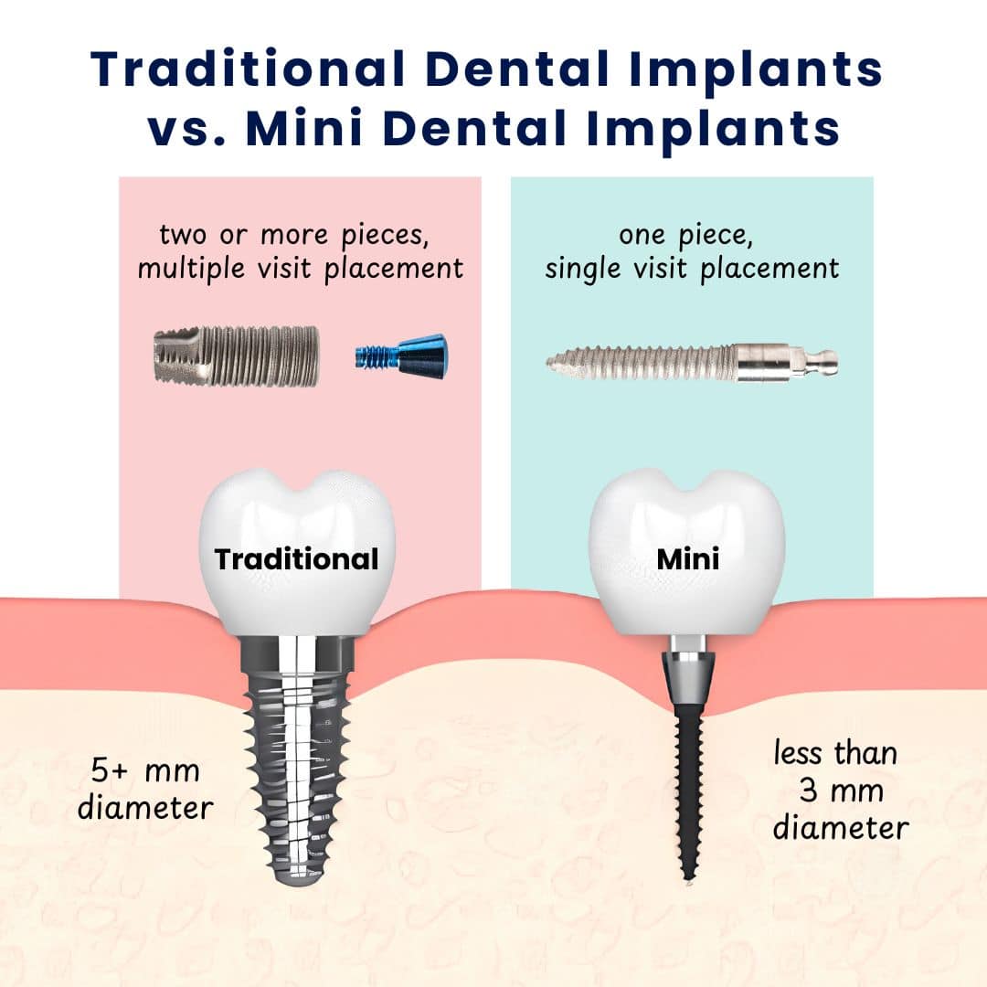 Illustrative example of mini dental implants vs regular implants from Google Search