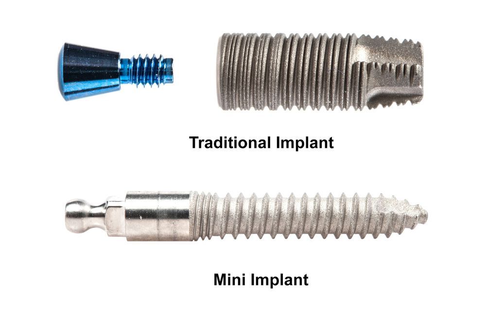 Illustrative example of mini dental implants vs traditional implants from Google Search