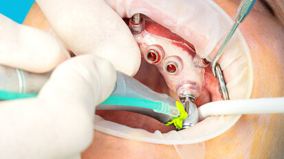 Illustrative example of mis implants dental from Google Search