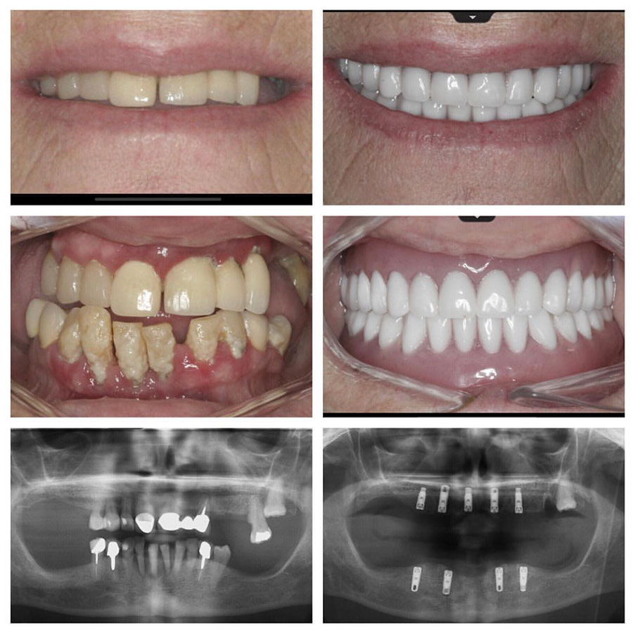 Illustrative example of multiple dental implants from Google Search