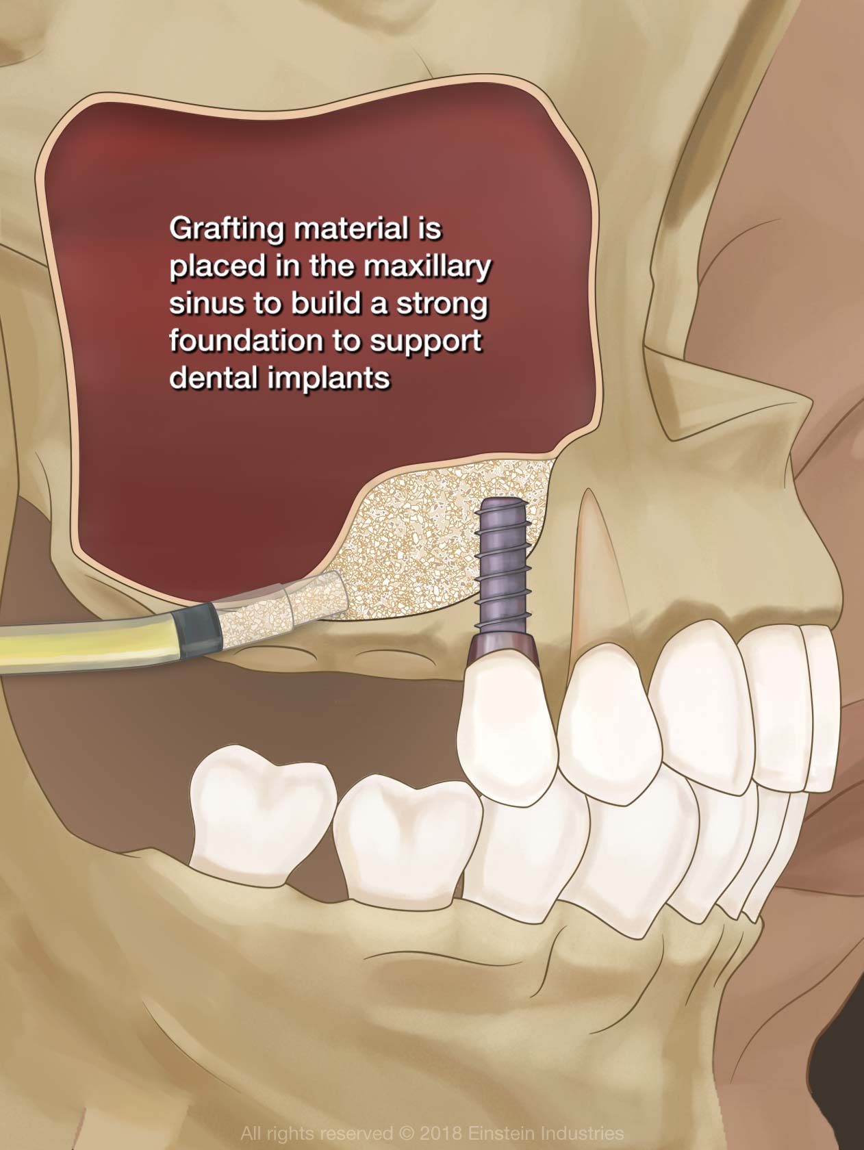 Illustrative example of nasal lift dental implants from Google Search