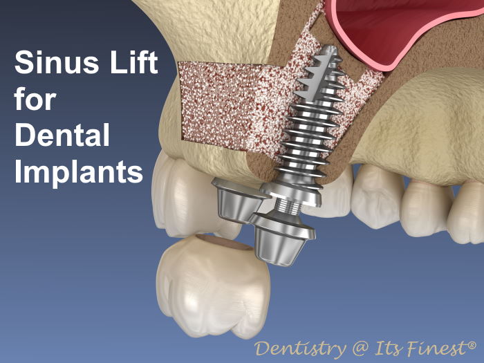 Illustrative example of nasal lift dental implants from Google Search