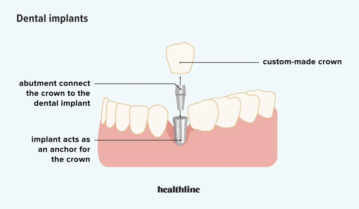 Illustrative example of negatives of dental implants from Google Search