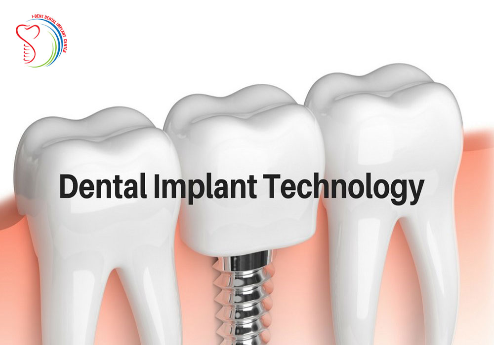 Illustrative example of new dental implant technology from Google Search