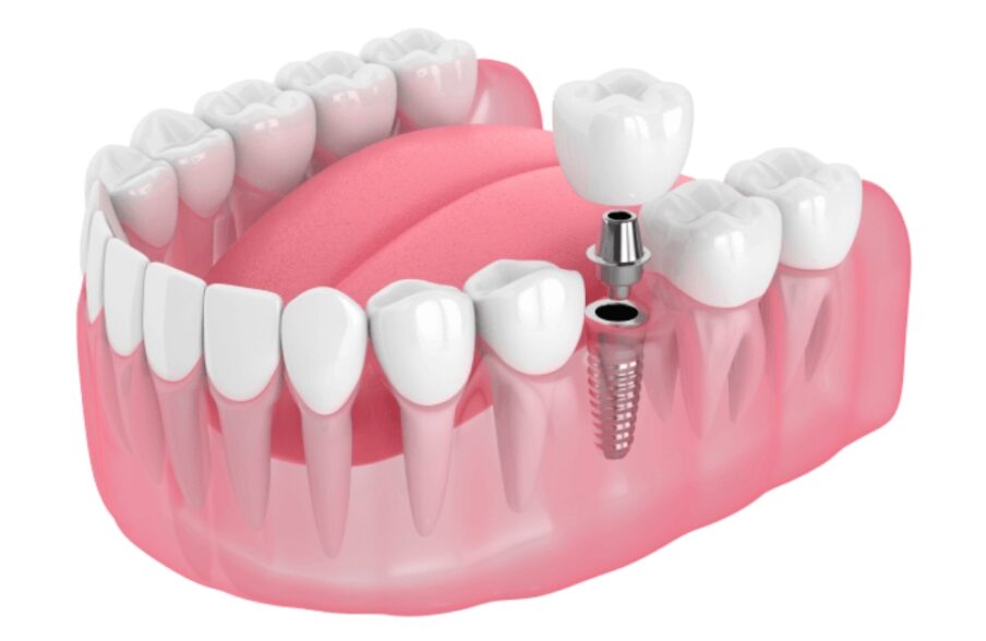 Illustrative example of new dental implants from Google Search