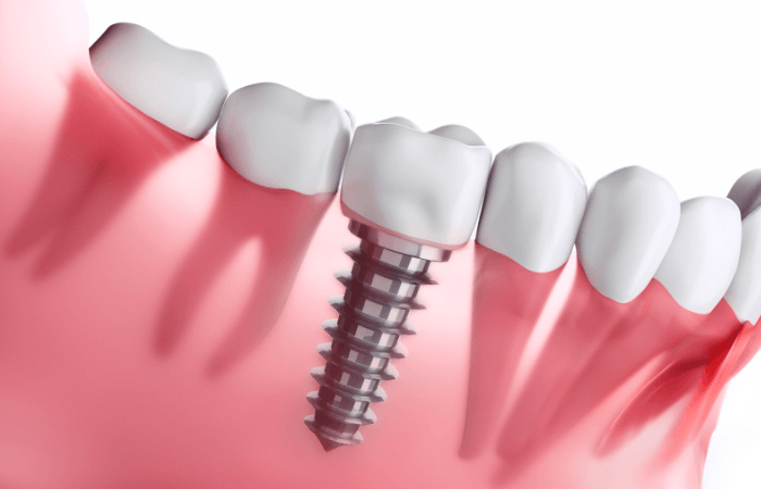 Illustrative example of new dental implants from Google Search