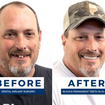 Illustrative example of nuvia dental implant reviews complaints from Google Search