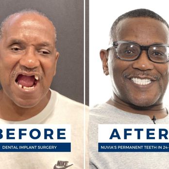 Illustrative example of nuvia dental implants reviews from Google Search