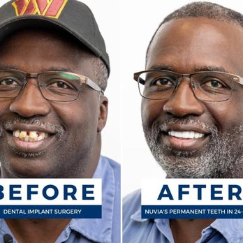Illustrative example of nuvia dental implants reviews from Google Search