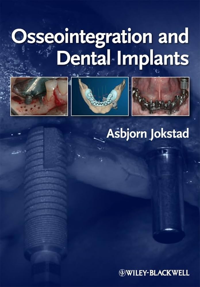 Illustrative example of osseointegration dental implants from Google Search