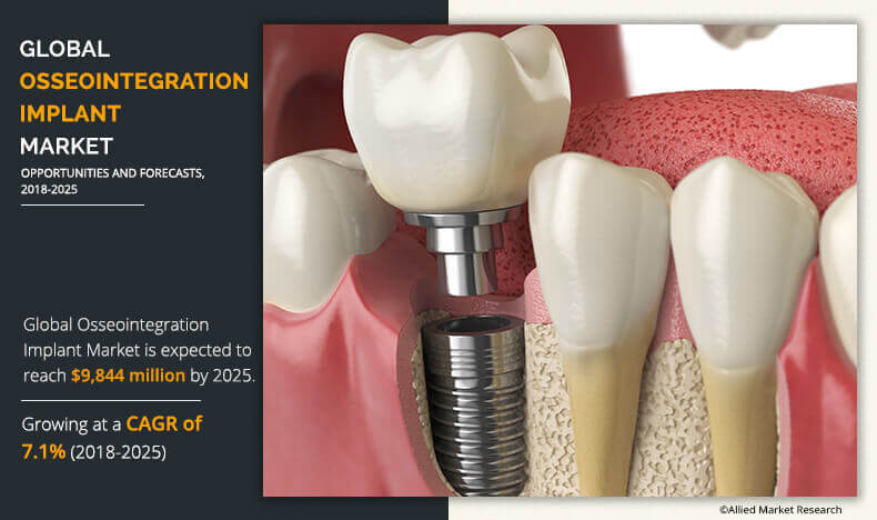 Illustrative example of osseointegration dental implants from Google Search