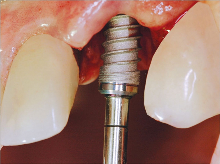 Illustrative example of osteoporosis and dental implants from Google Search
