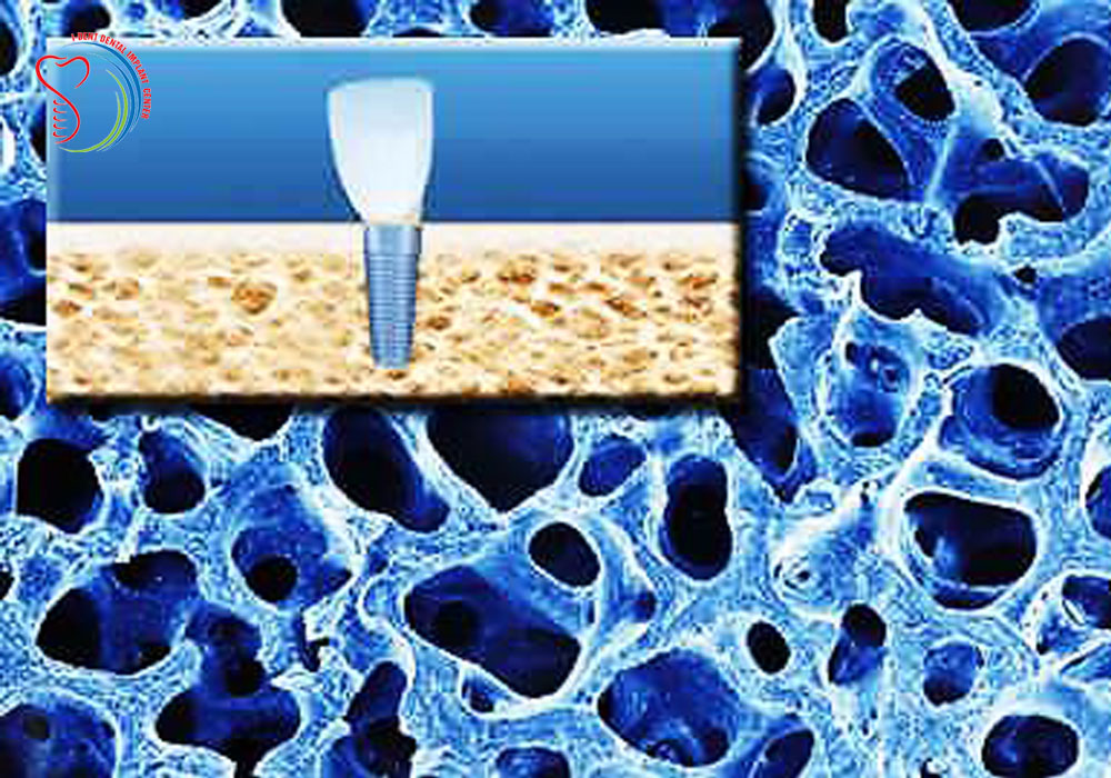 Illustrative example of osteoporosis and dental implants from Google Search