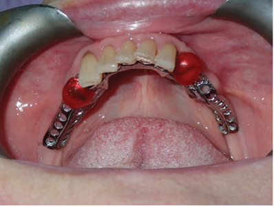 Illustrative example of partial dental implants from Google Search