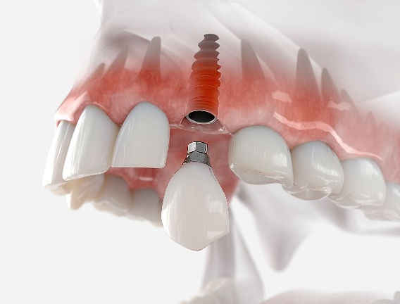 Illustrative example of periodontics and dental implants from Google Search