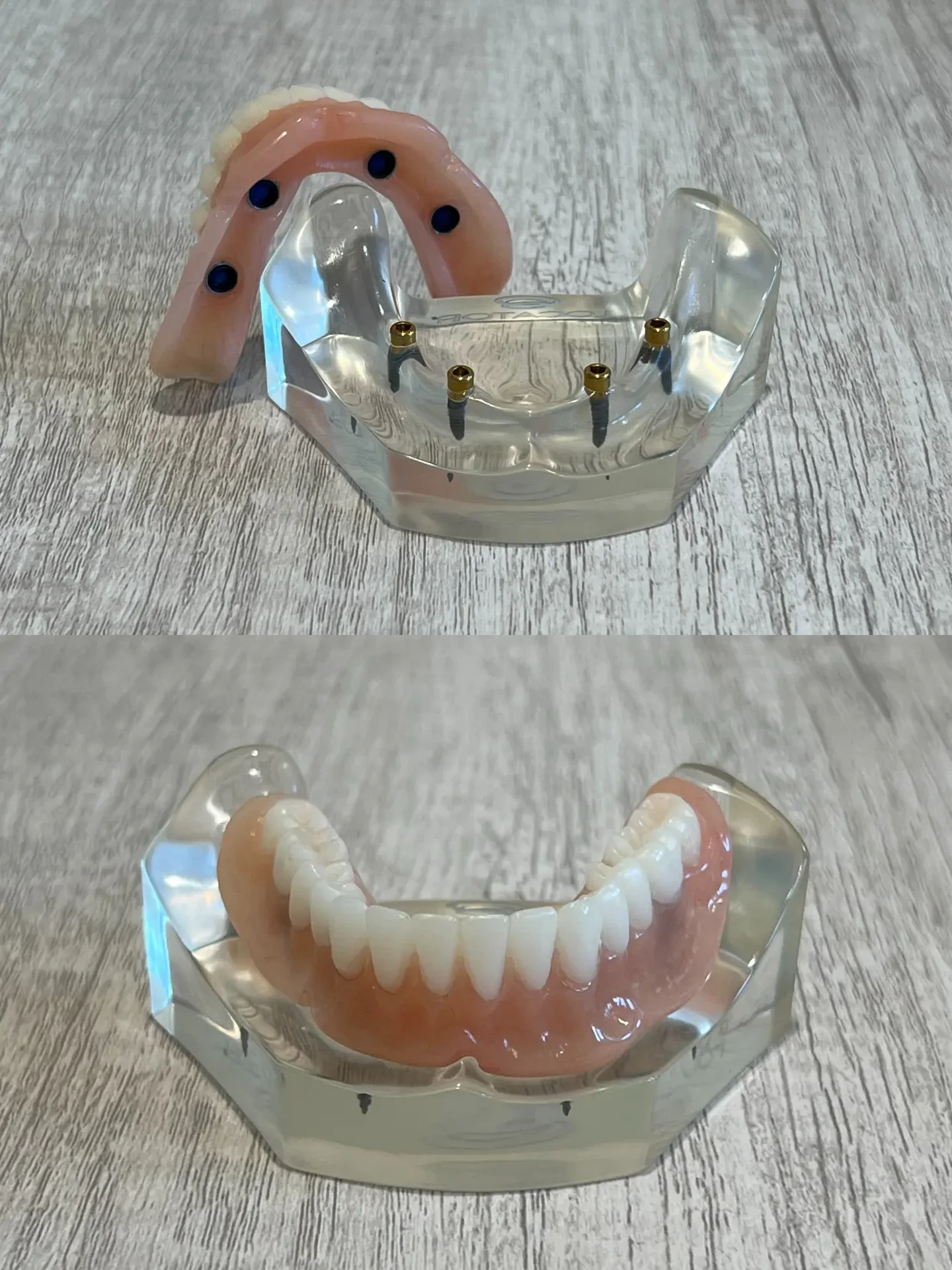 Illustrative example of pictures of dental implants for dentures from Google Search