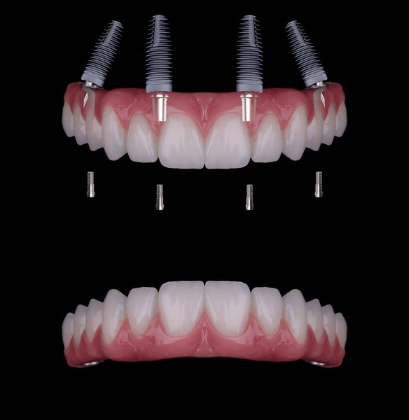 Illustrative example of pictures of dental implants from Google Search