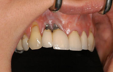 Illustrative example of pictures of dental implants that failed from Google Search