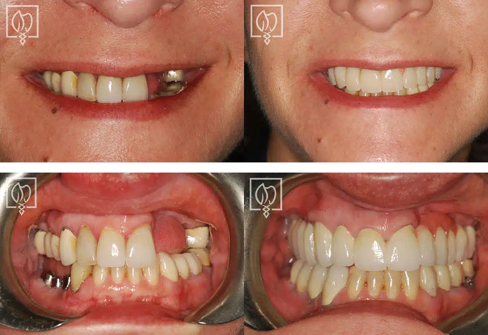 Illustrative example of pictures of dental implants that failed from Google Search