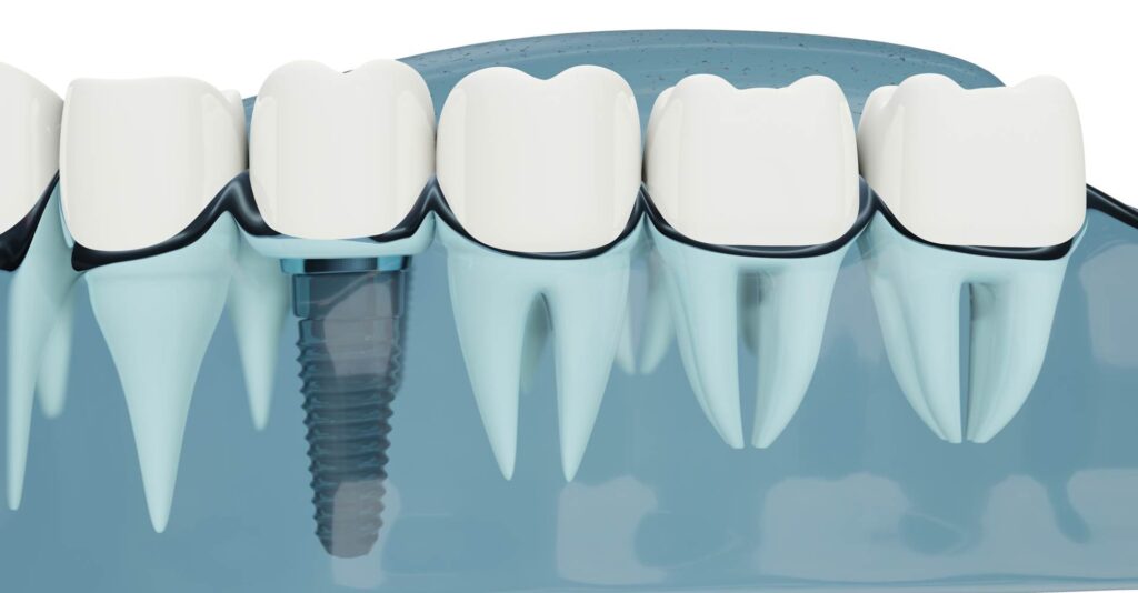 Illustrative example of pros & cons of dental implants from Google Search