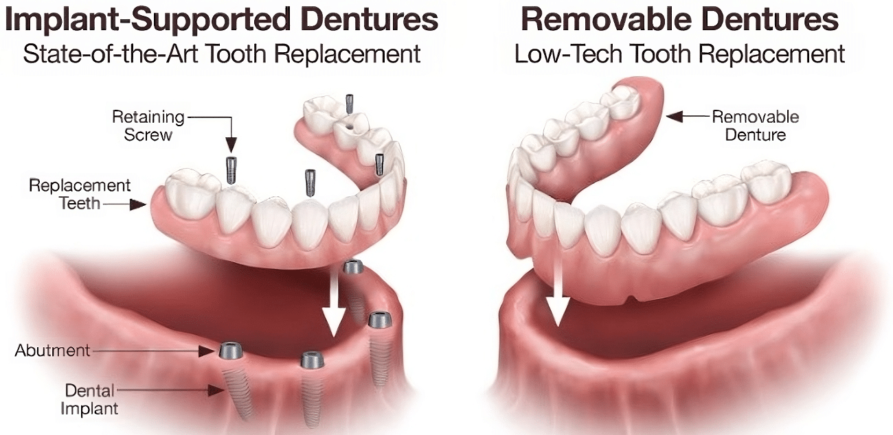 Illustrative example of pros & cons of dental implants from Google Search