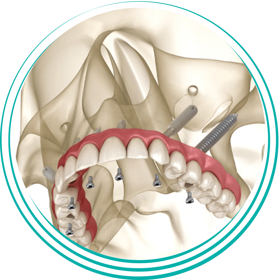 Illustrative example of pterygoid dental implants from Google Search