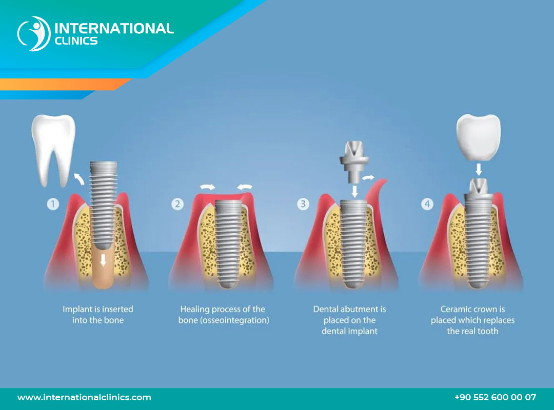Illustrative example of recovery from dental implants from Google Search