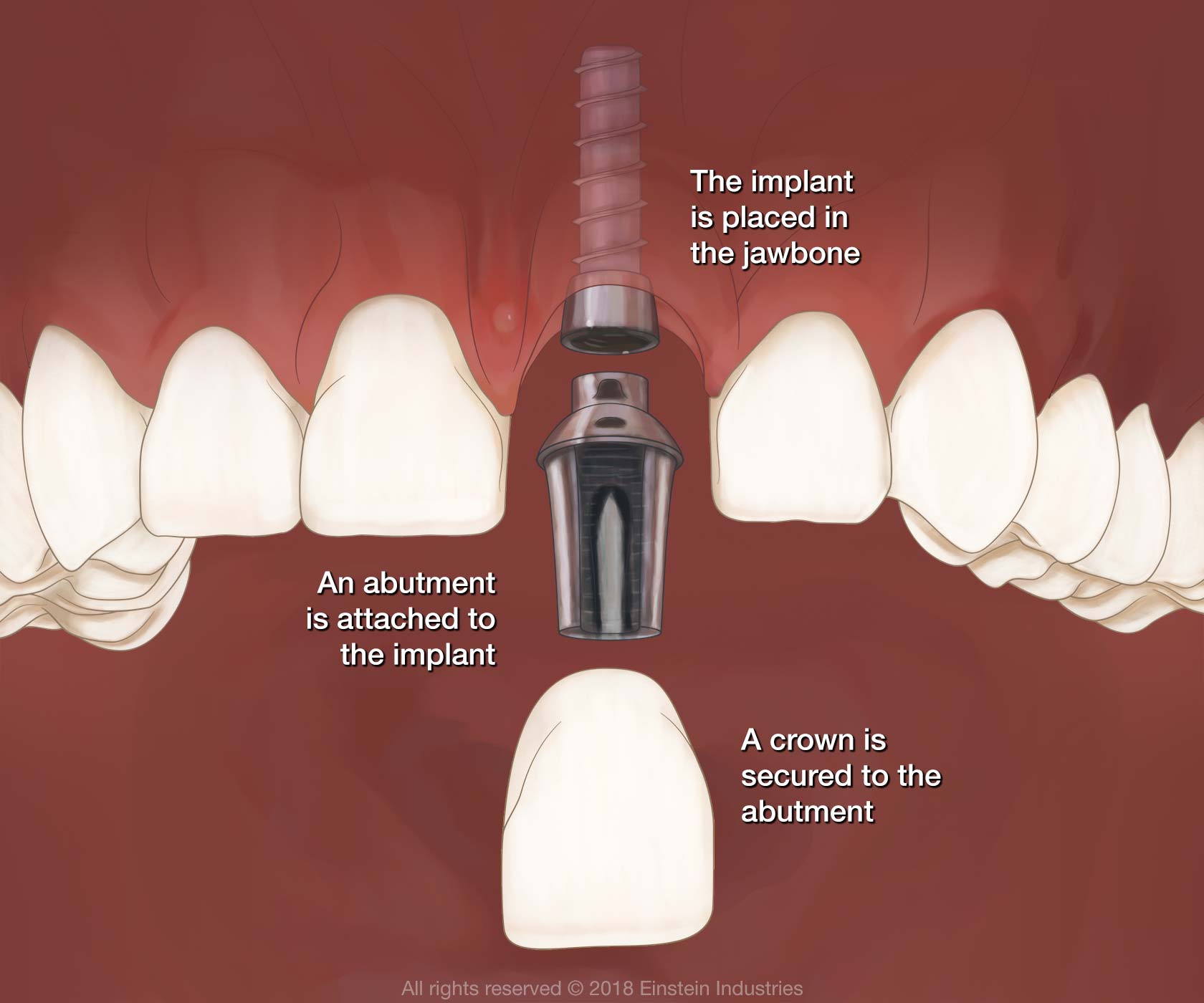 Illustrative example of recovery from dental implants from Google Search