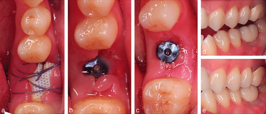 Illustrative example of recovery time from dental implants from Google Search
